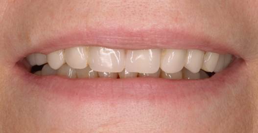 le nostre procedure per avere in 24ore denti fissi e sani - Studio Sabiu