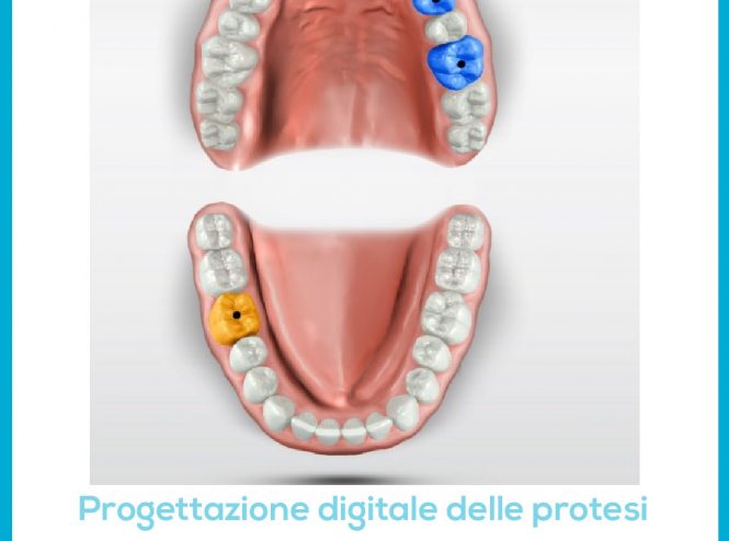 Realizzazione della protesi digitale presso lo studio Sabiu a San Giovanni Suergiu