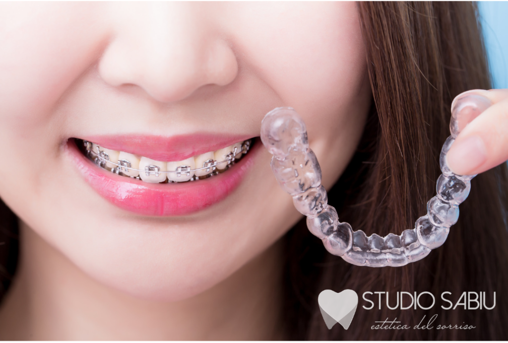 Che apparecchio utilizzare per riallineare i denti? Studio Sabiu - San Giovanni Suergiu