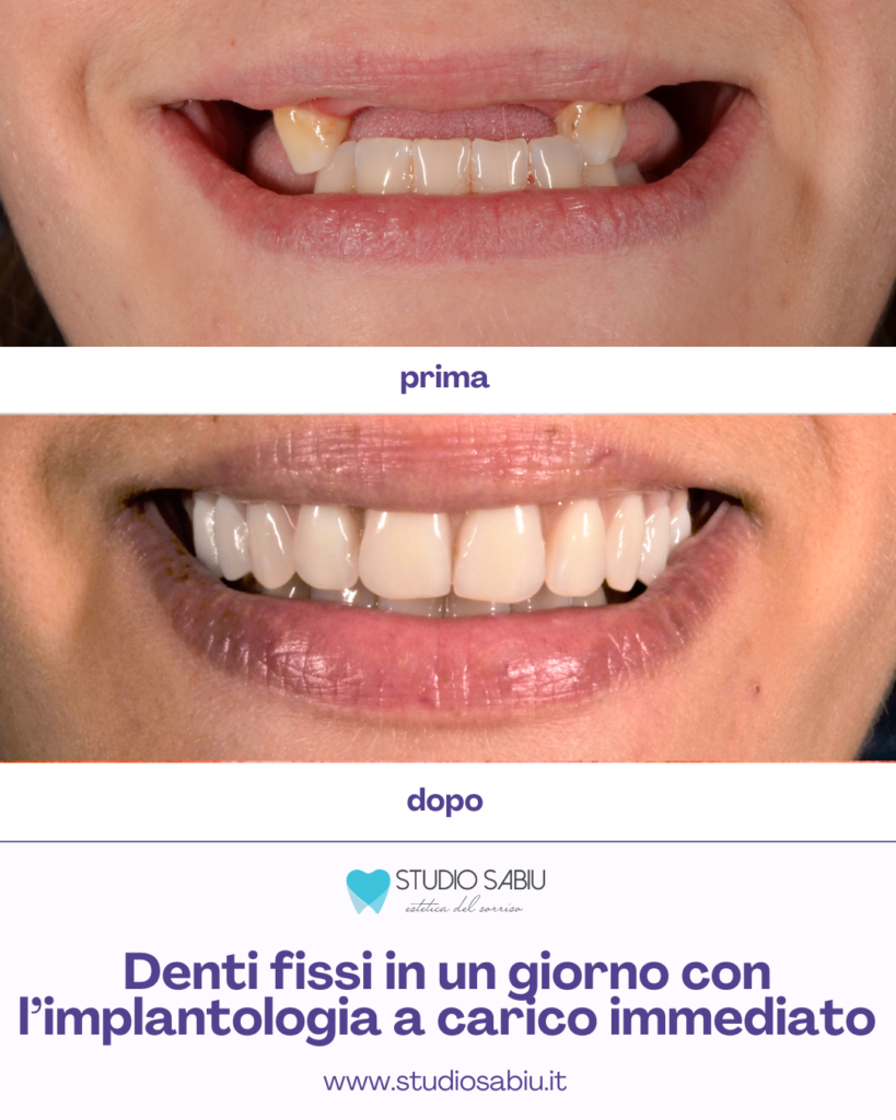 Intervento di implantologia a carico immediato. Il tuo sorriso in 24ore presso lo studio Sabiu a San Giovanni Suergiu