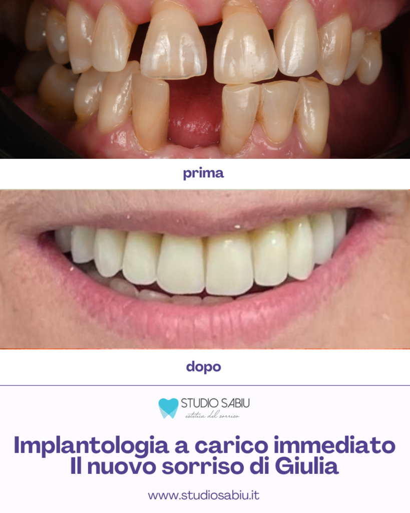 il caso di Giulia e del suo nuovo sorriso grazie all'implantologia a carico immediato.